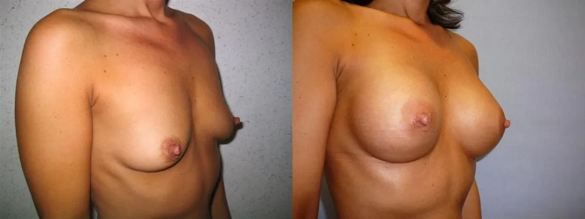 Збільшення грудей – Аугментація – результат 27