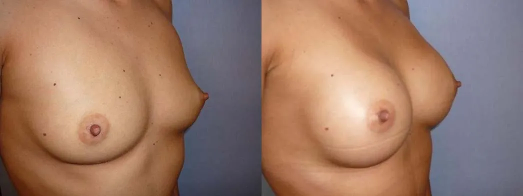 Збільшення грудей – Аугментація – результат 28