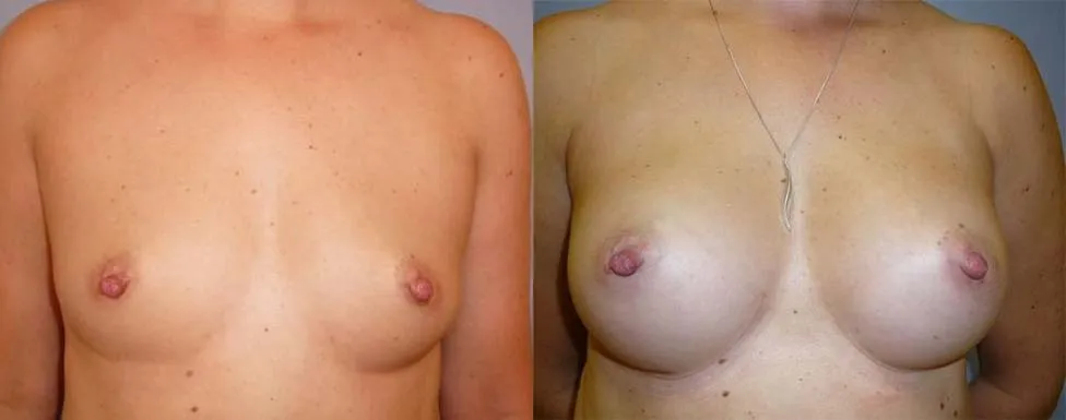 Збільшення грудей – Аугментація – результат 30