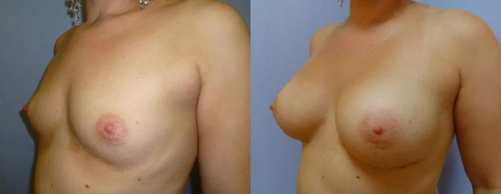 Збільшення грудей – Аугментація – результат 32