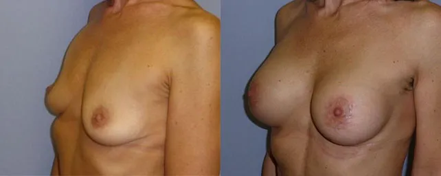 Збільшення грудей – Аугментація – результат 33