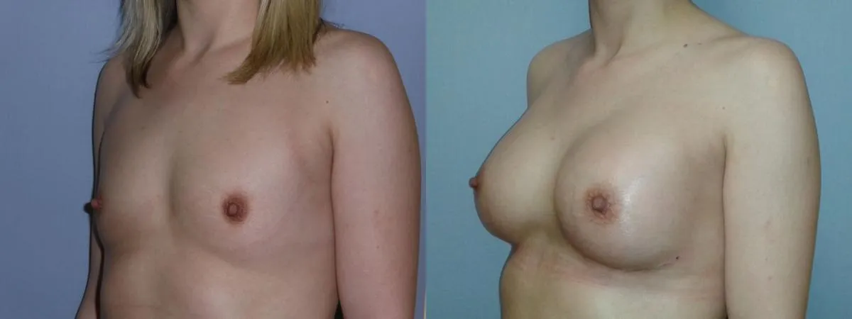 Збільшення грудей (Аугментація) – результат 5