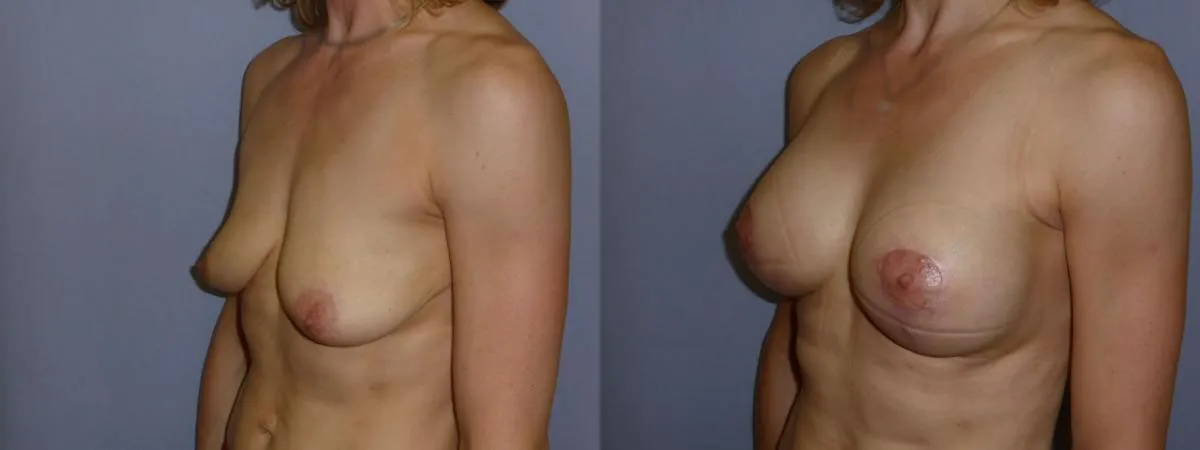 Збільшення грудей – Аугментація – результат 36