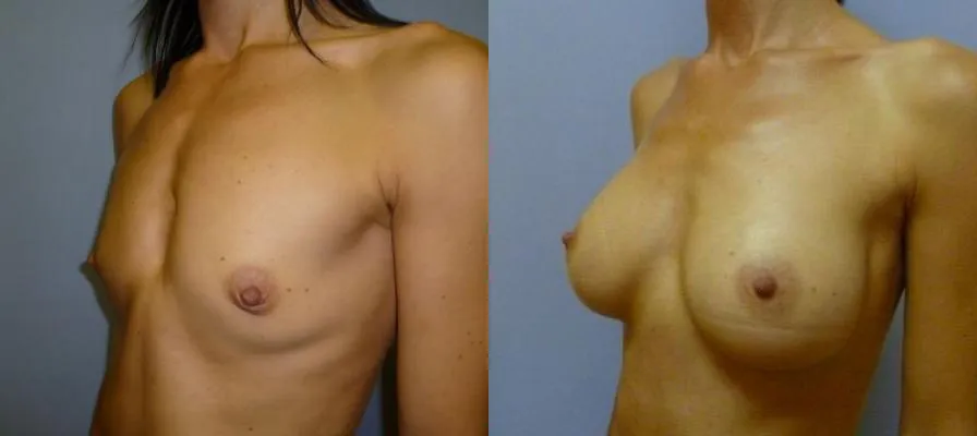 Збільшення грудей – Аугментація – результат 38