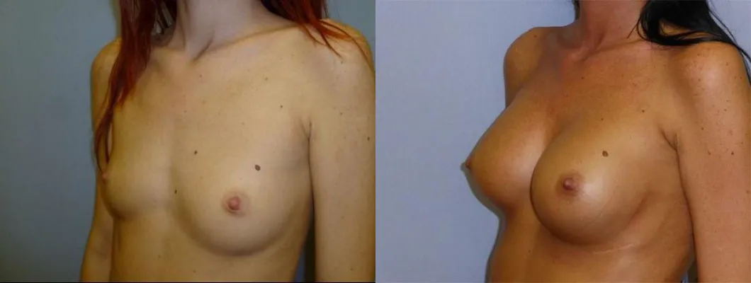 Збільшення грудей – Аугментація – результат 40