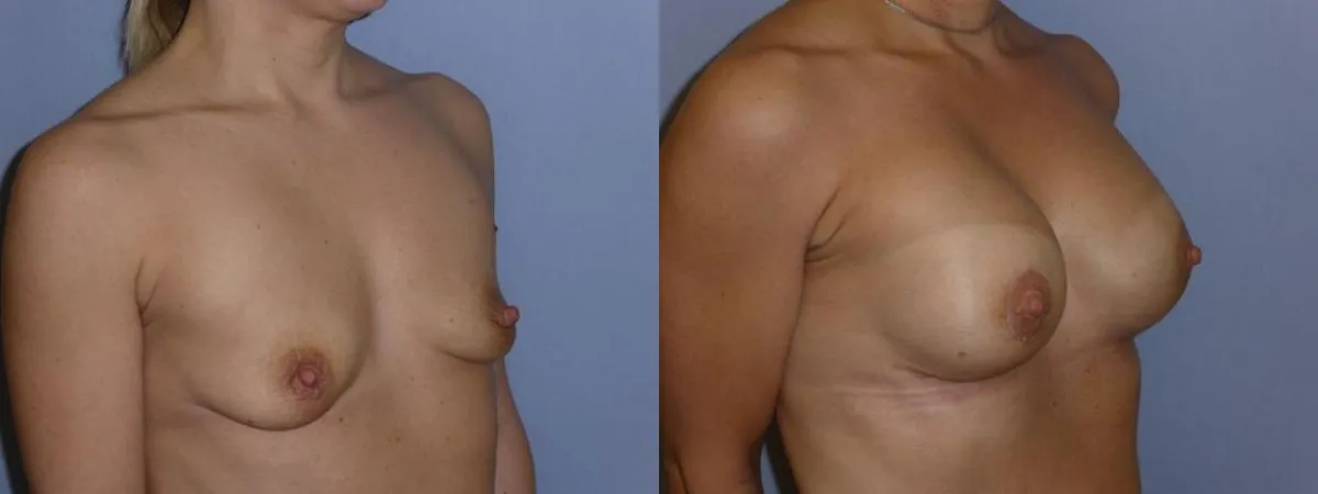 Збільшення грудей – Аугментація – результат 41