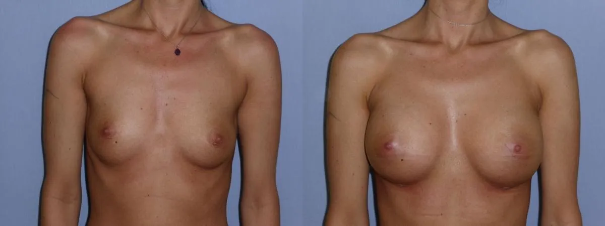 Збільшення грудей (Аугментація) – результат 6