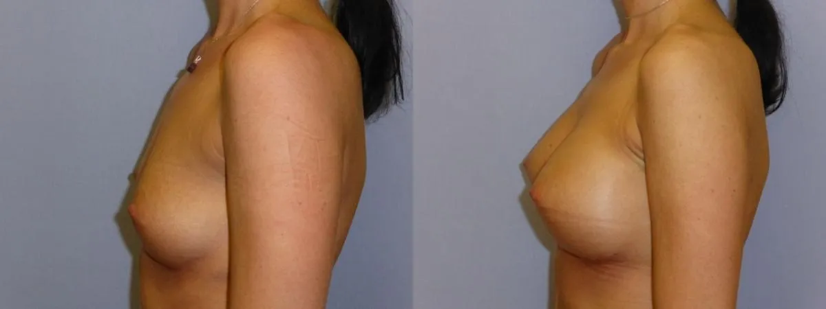 Збільшення грудей – Аугментація – результат 44