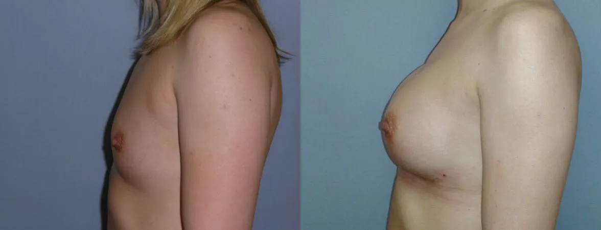 Збільшення грудей – Аугментація – результат 48
