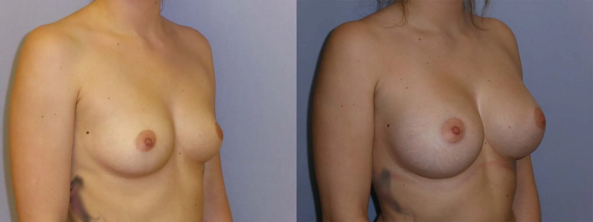 Збільшення грудей – Аугментація – результат 49