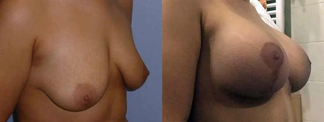 Збільшення грудей – Аугментація – результат 50