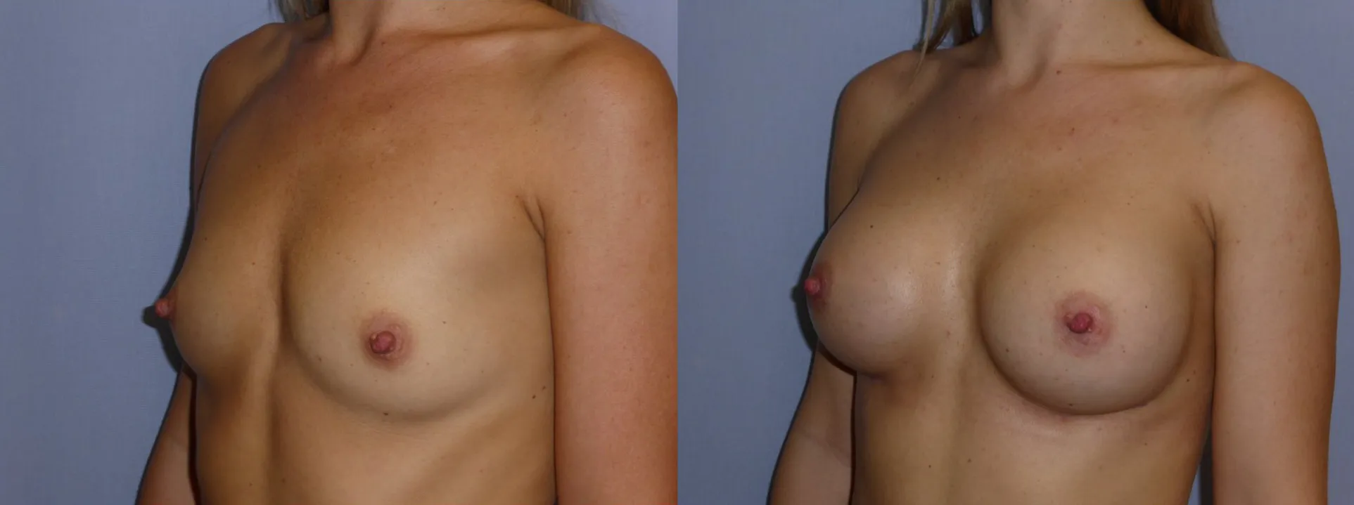 Збільшення грудей – Аугментація – результат 52