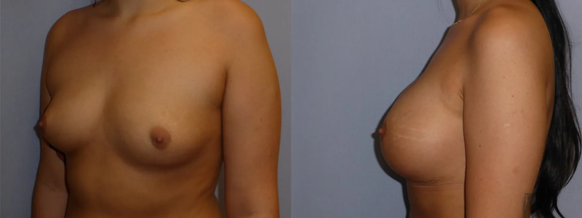 Збільшення грудей – Аугментація – результат 53