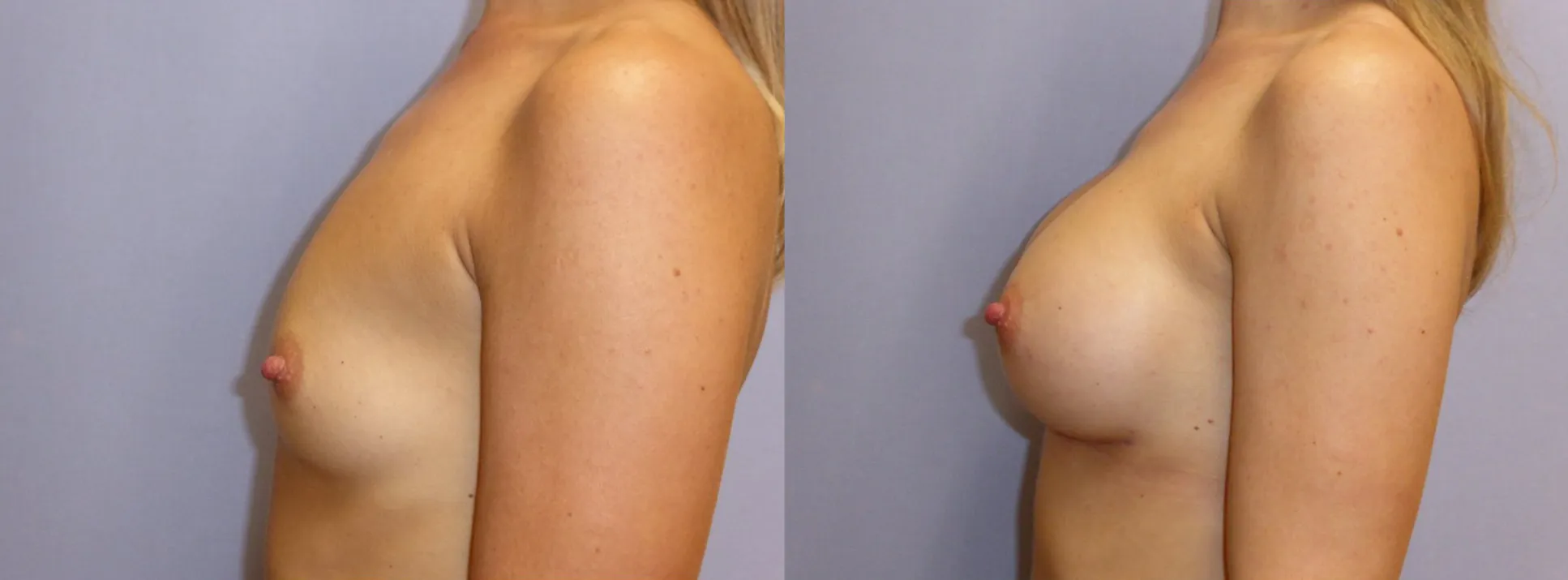 Збільшення грудей – Аугментація – результат 54