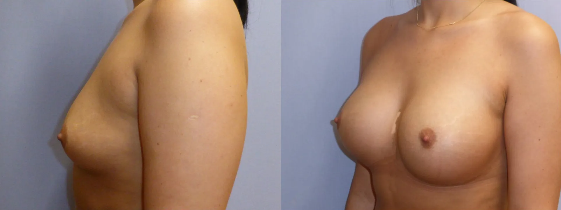 Збільшення грудей – Аугментація – результат 55