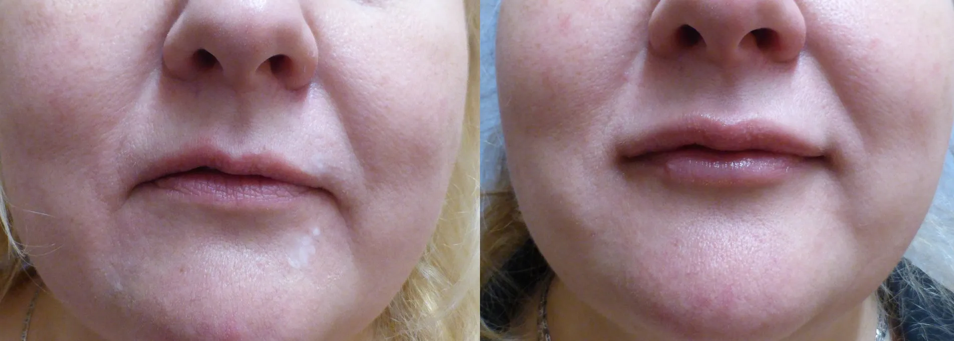 Збільшення губ (Аугментація) – результат 1