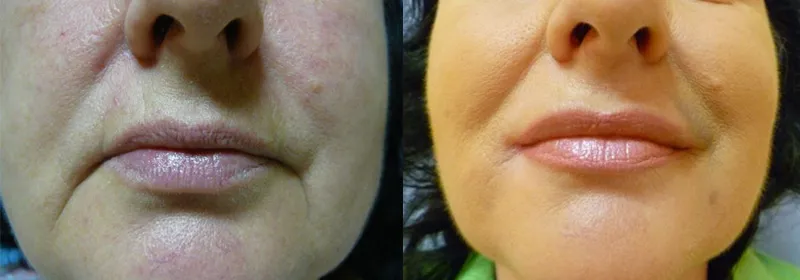 Збільшення губ (Аугментація) – результат 2