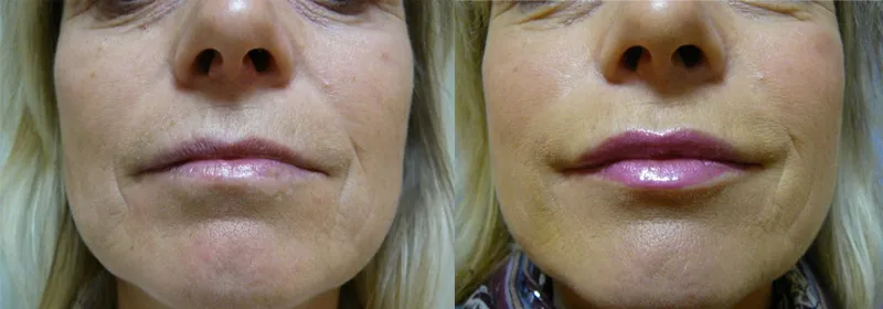 Збільшення губ (Аугментація) – результат 3