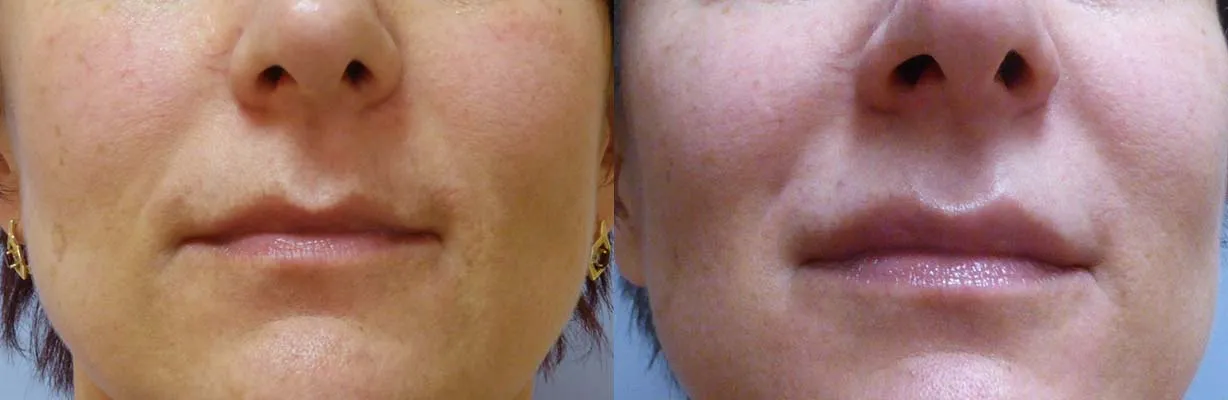 Збільшення губ (Аугментація) – результат 4