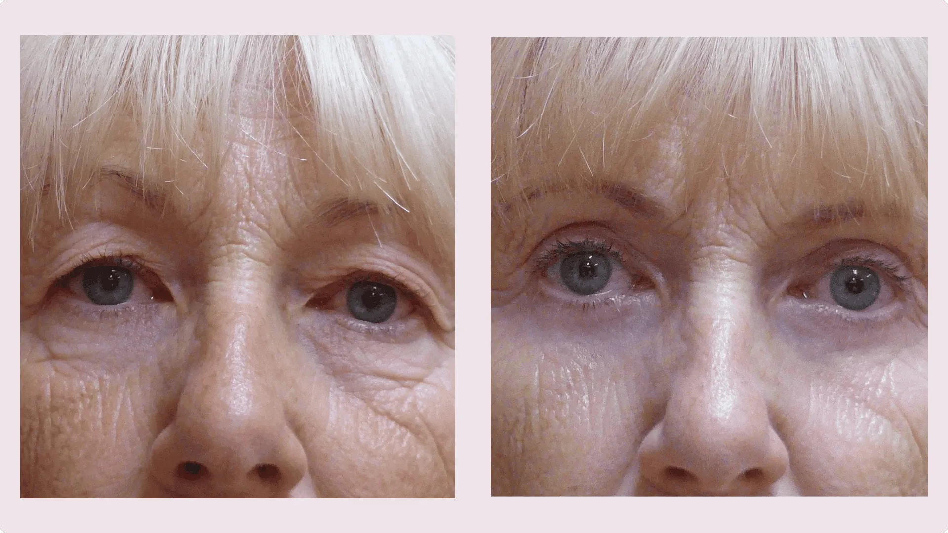 Korekce víček (Blefaroplastika) – fotografie před a po 1