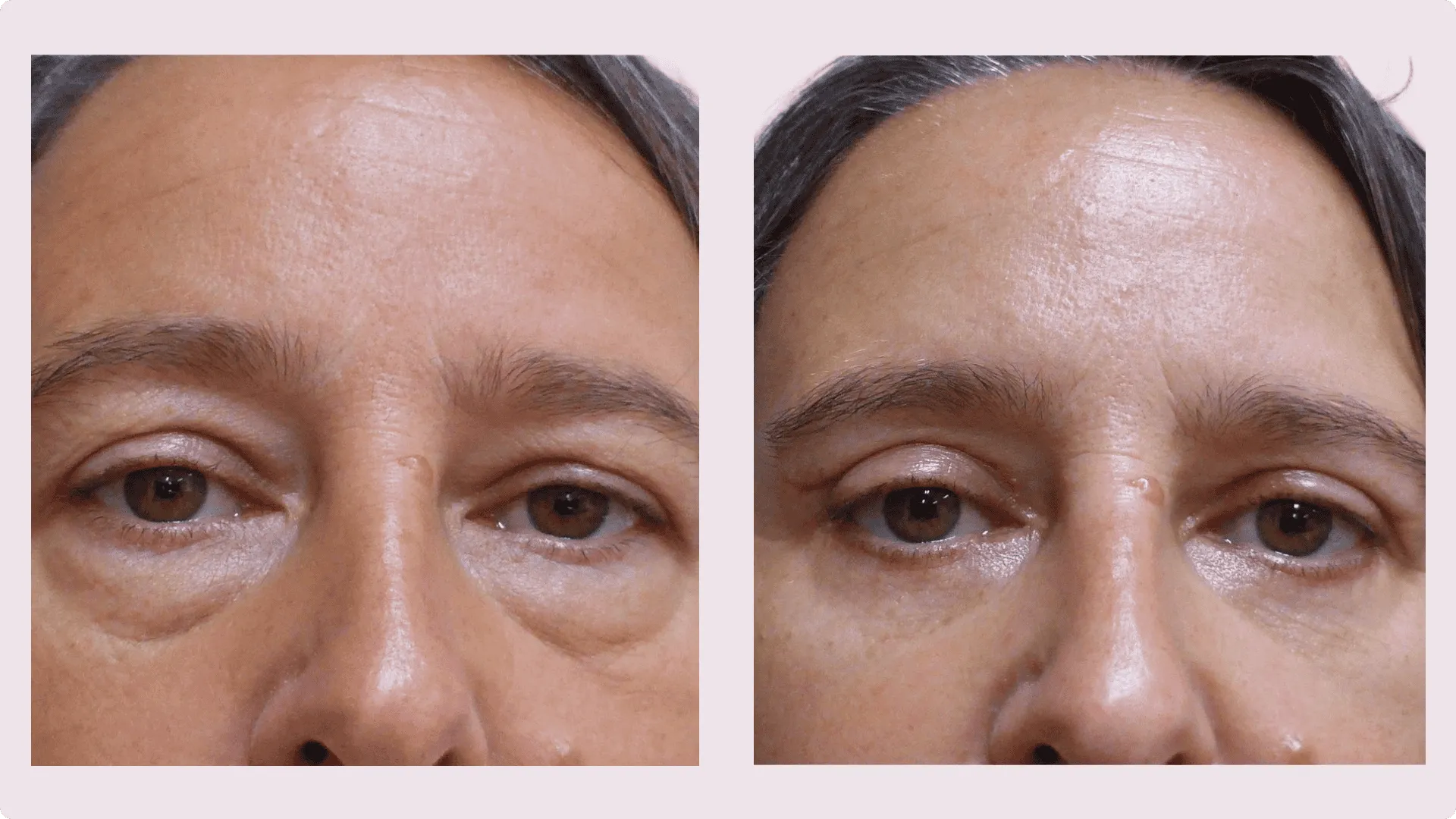 Lidkorrektur – Blepharoplastik – Vorher-Nachher-Foto 4