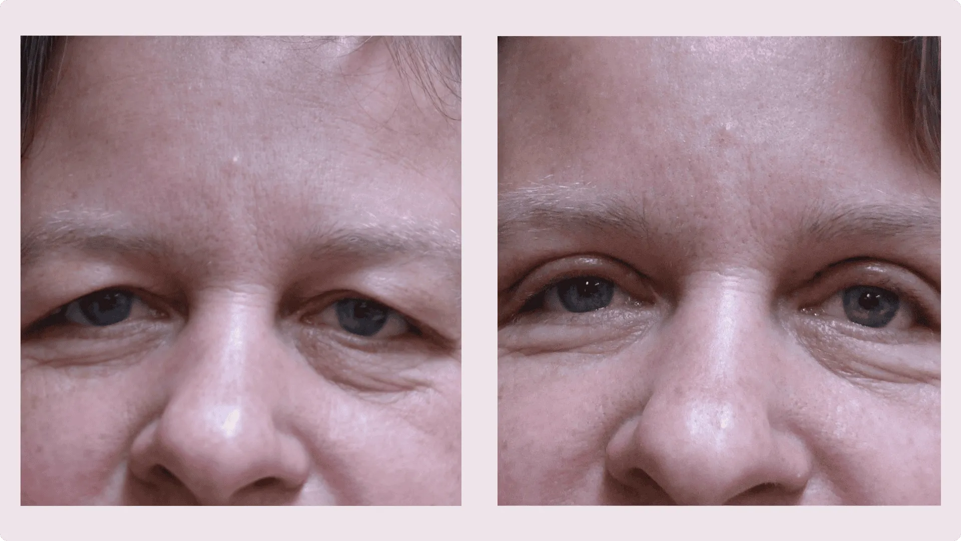 Lidkorrektur – Blepharoplastik – Vorher-Nachher-Foto 5