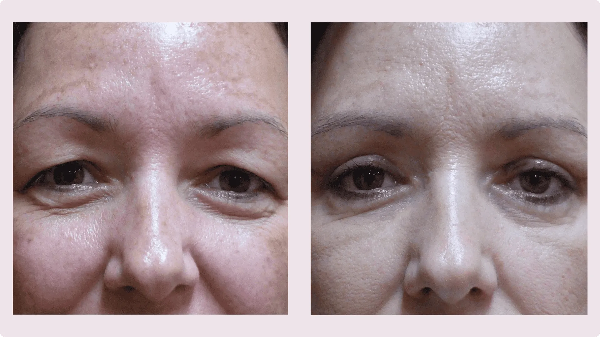 Korekce víček (Blefaroplastika) – fotografie před a po 2