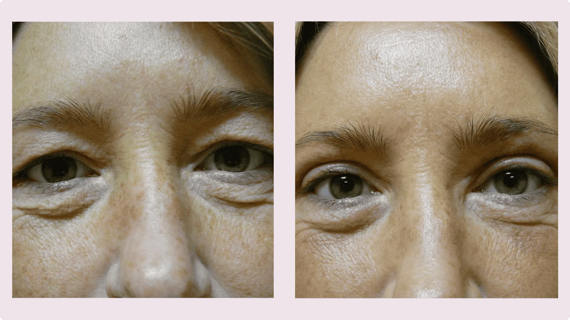 Lidkorrektur – Blepharoplastik – Vorher-Nachher-Foto 6
