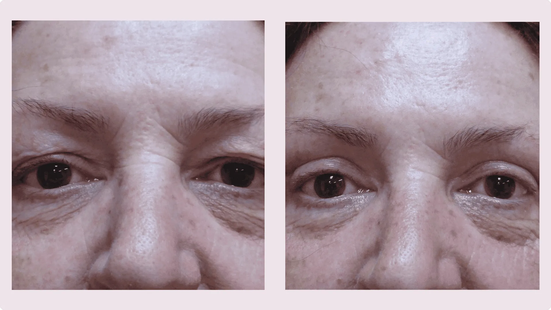 Lidkorrektur – Blepharoplastik – Vorher-Nachher-Foto 7