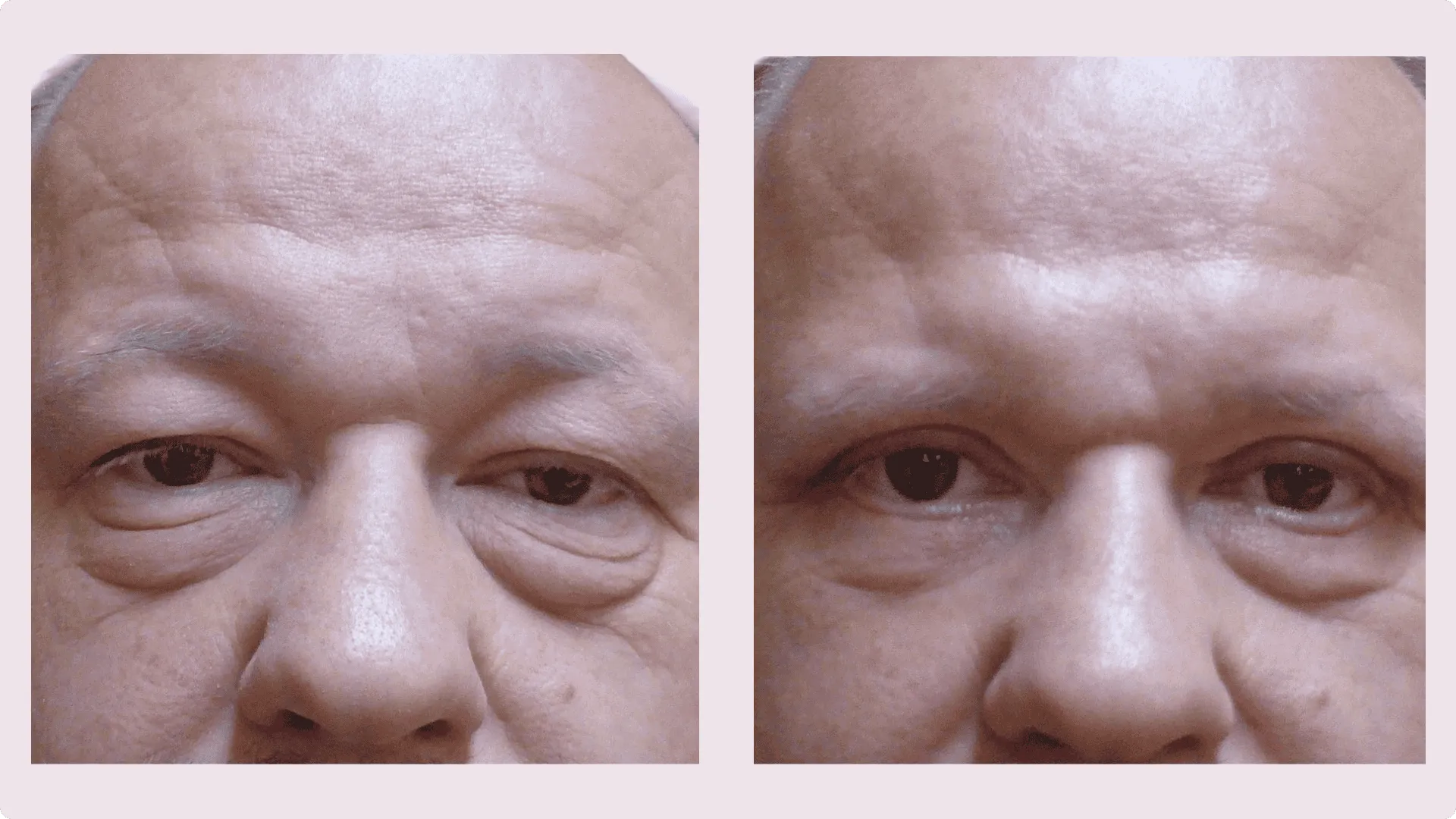Korekce víček (Blefaroplastika) – fotografie před a po 3