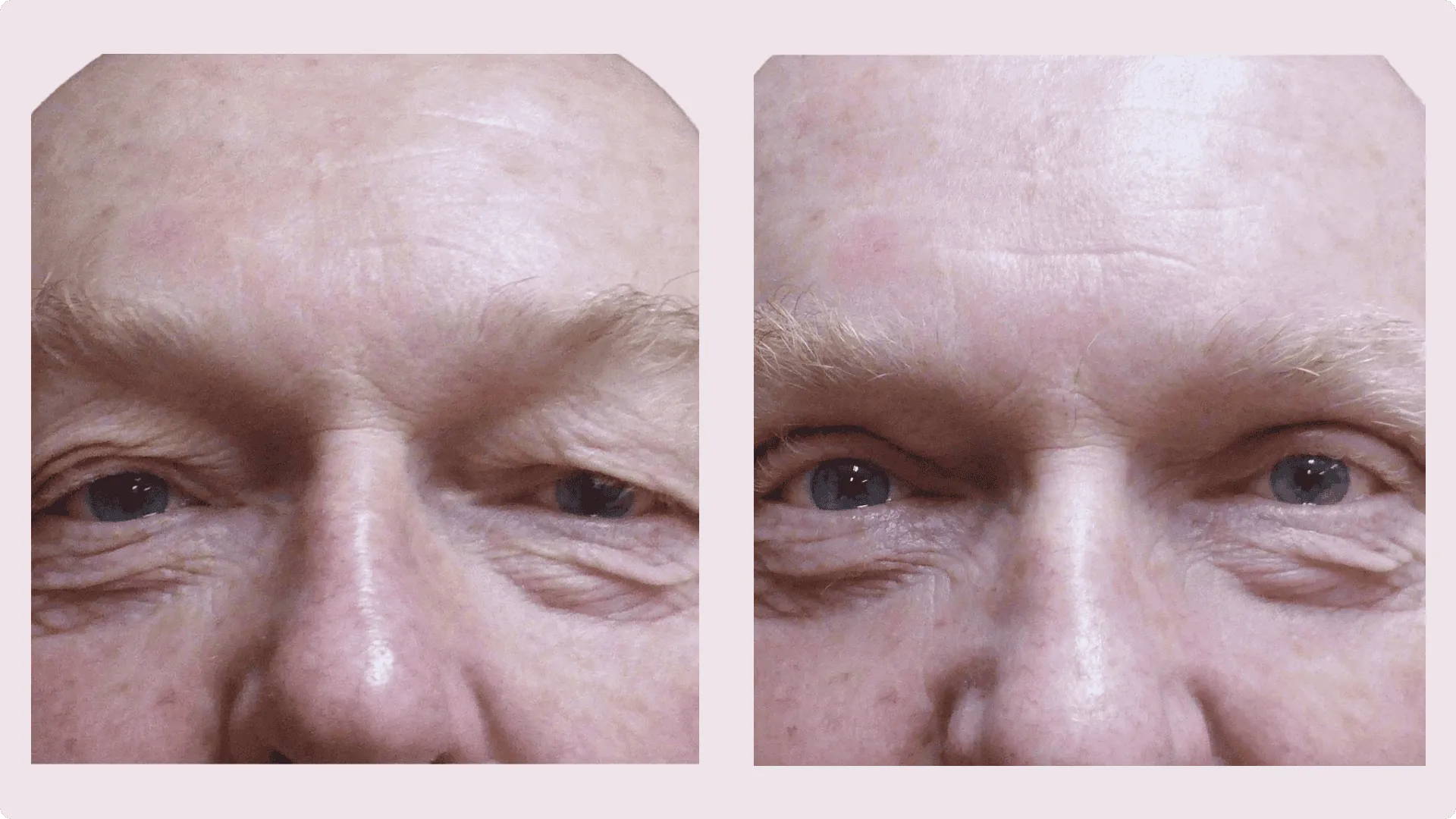 Eyelid Correction – Blepharoplasty – before and after photo 5
