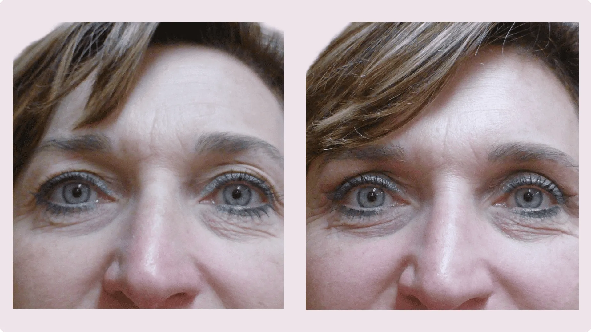 Eyelid Correction – Blepharoplasty – before and after photo 6