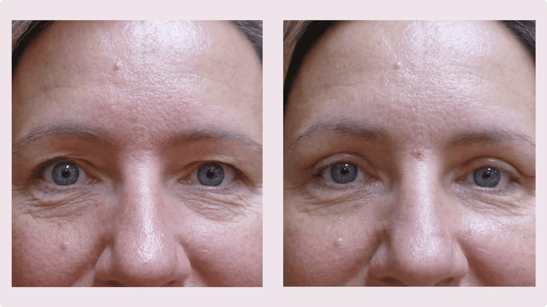 Korekce víček (Blefaroplastika) – fotografie před a po 4