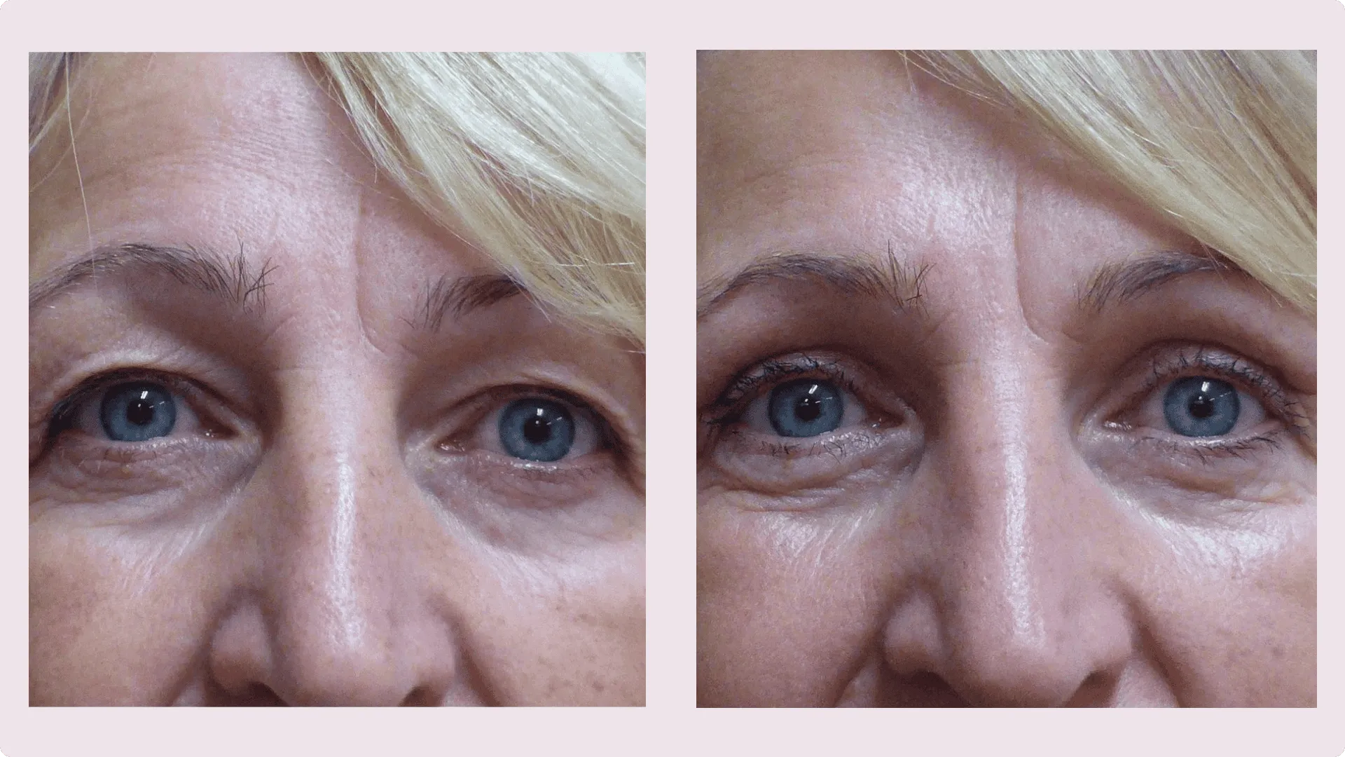 Eyelid Correction – Blepharoplasty – before and after photo 8