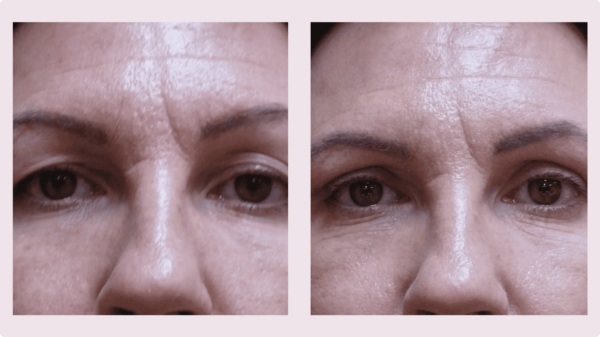 Eyelid Correction – Blepharoplasty – before and after photo 9