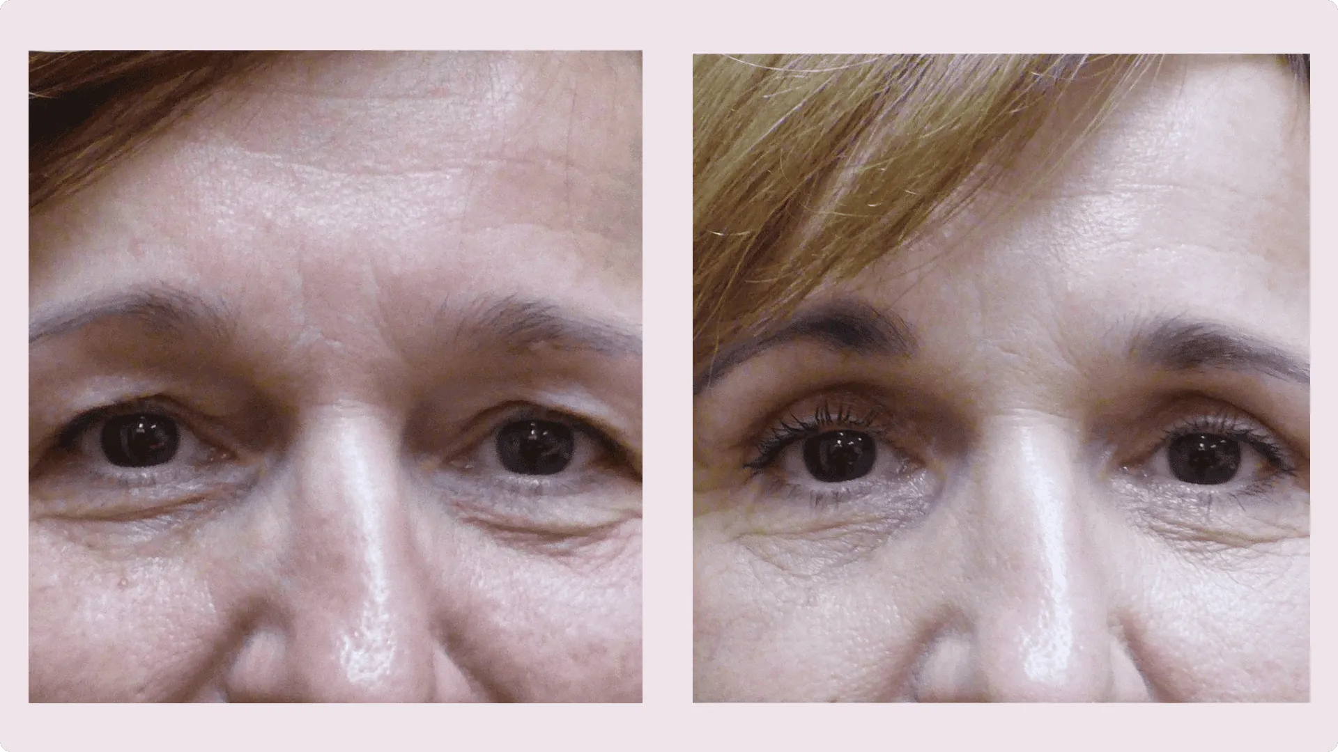 Korekce víček (Blefaroplastika) – fotografie před a po 5
