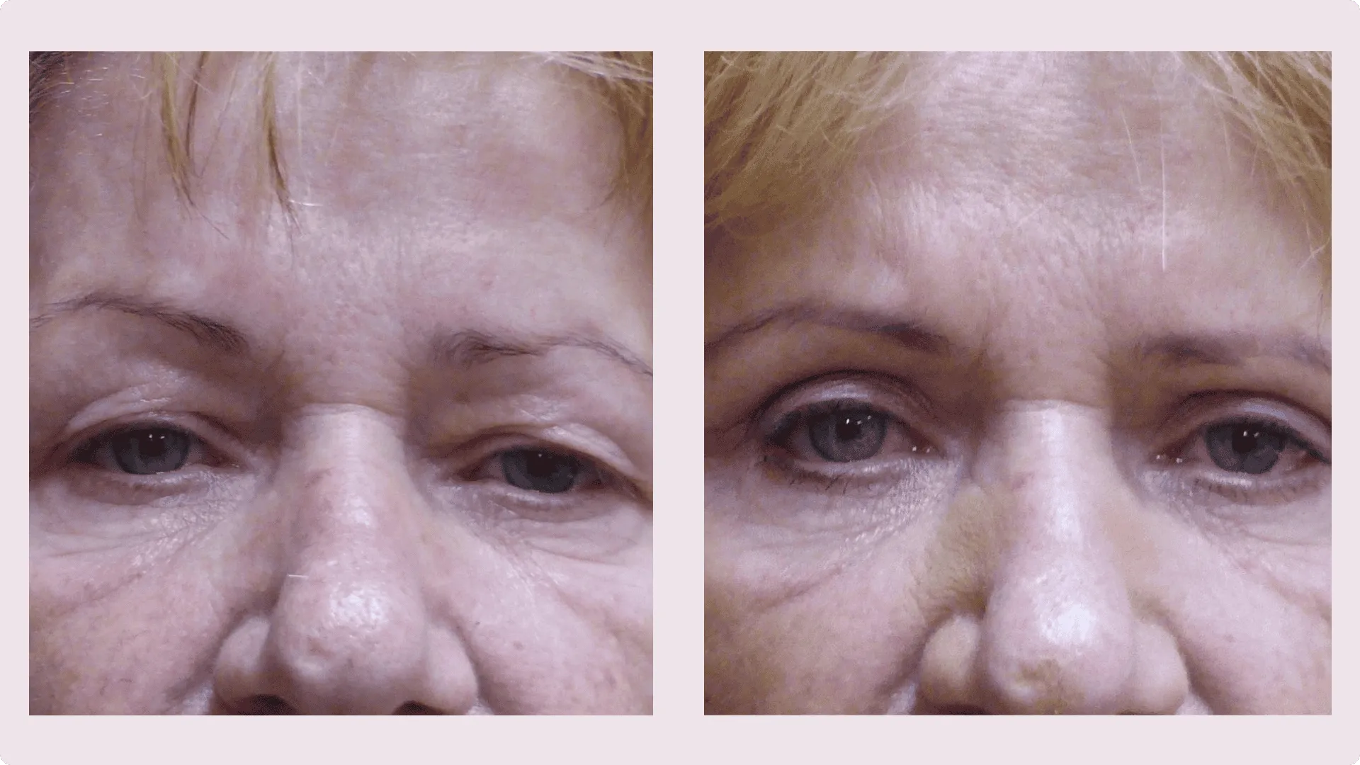 Eyelid Correction – Blepharoplasty – before and after photo 11