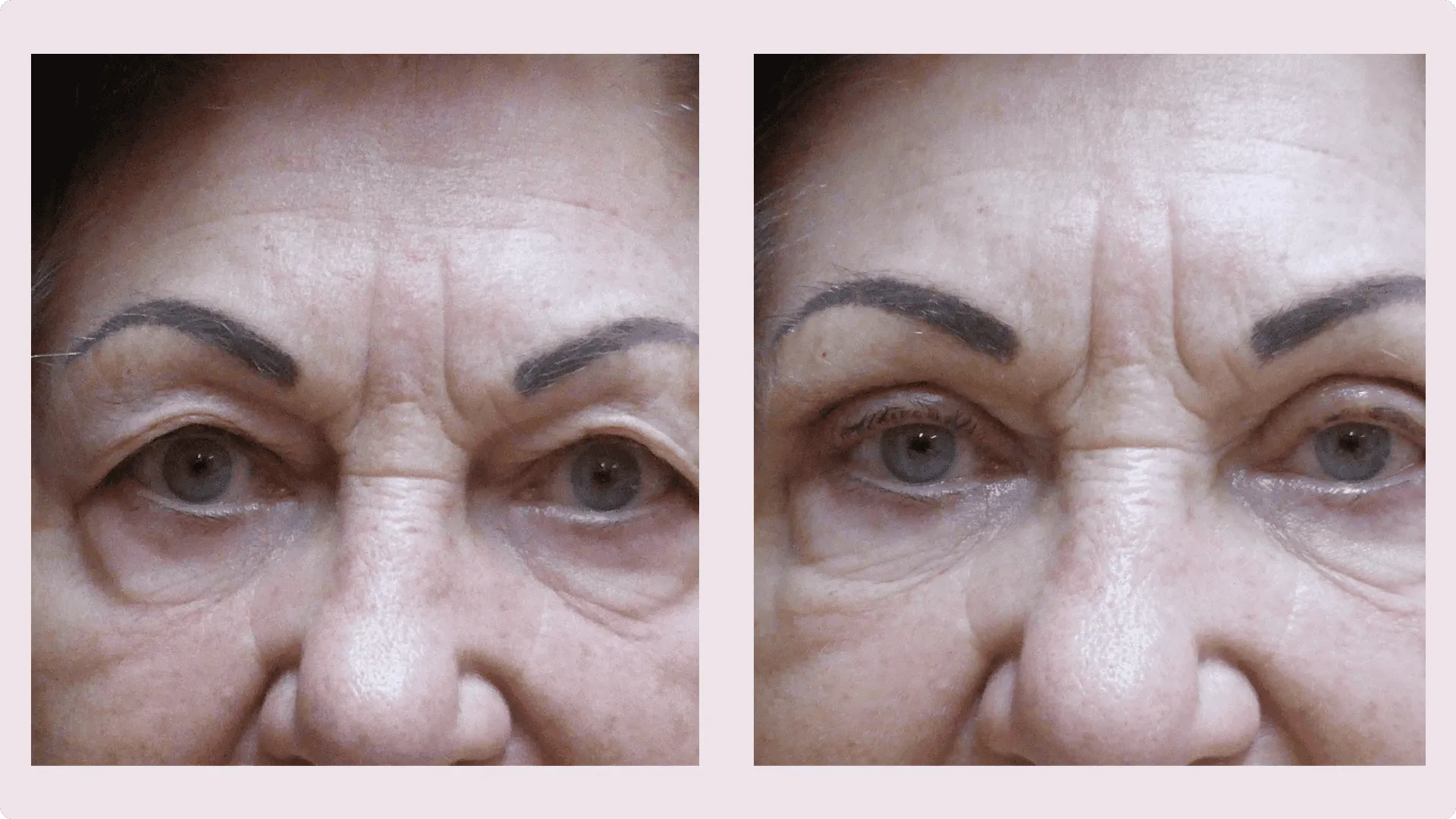 Eyelid Correction – Blepharoplasty – before and after photo 12
