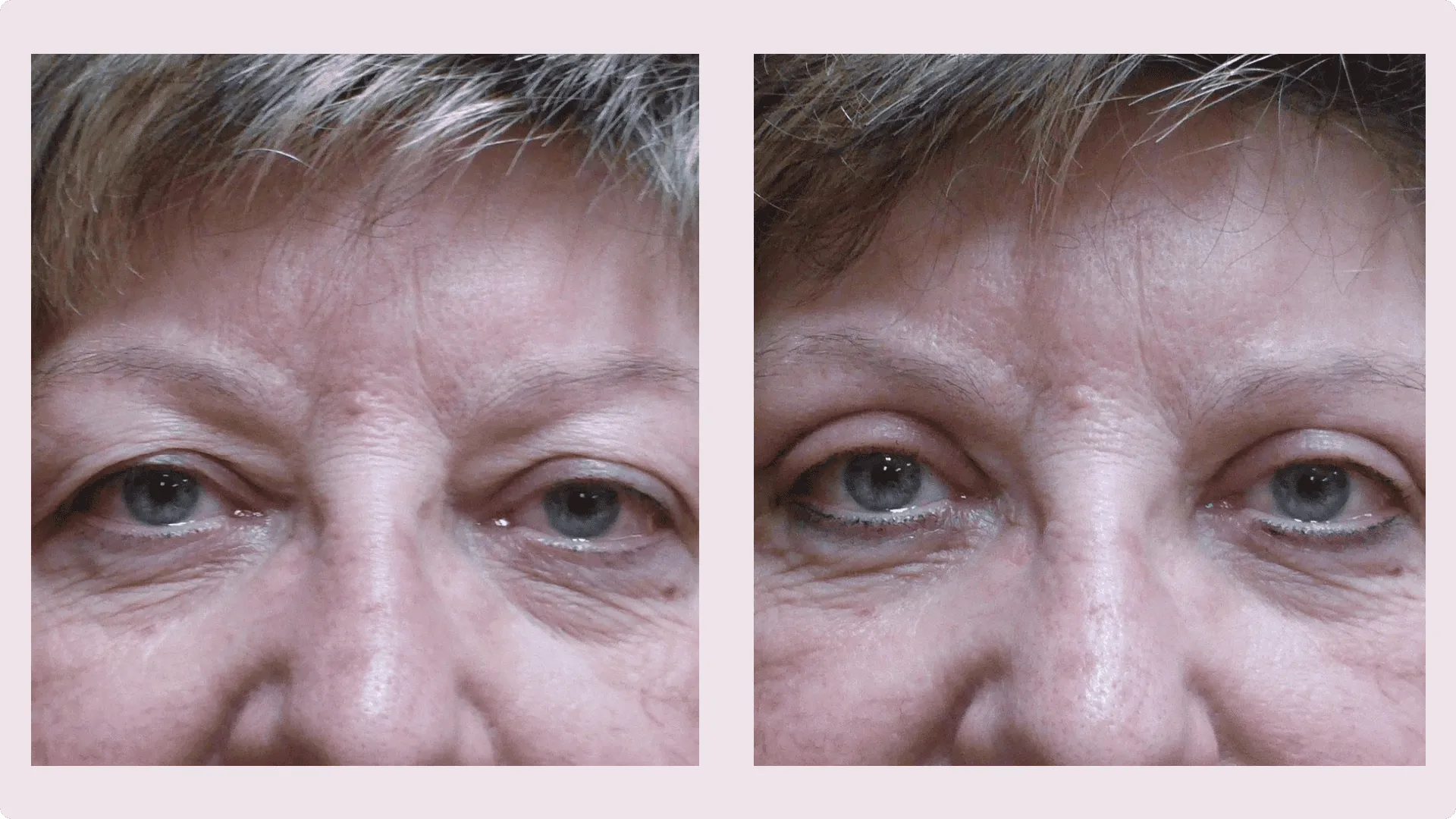 Korekce víček (Blefaroplastika) – fotografie před a po 6