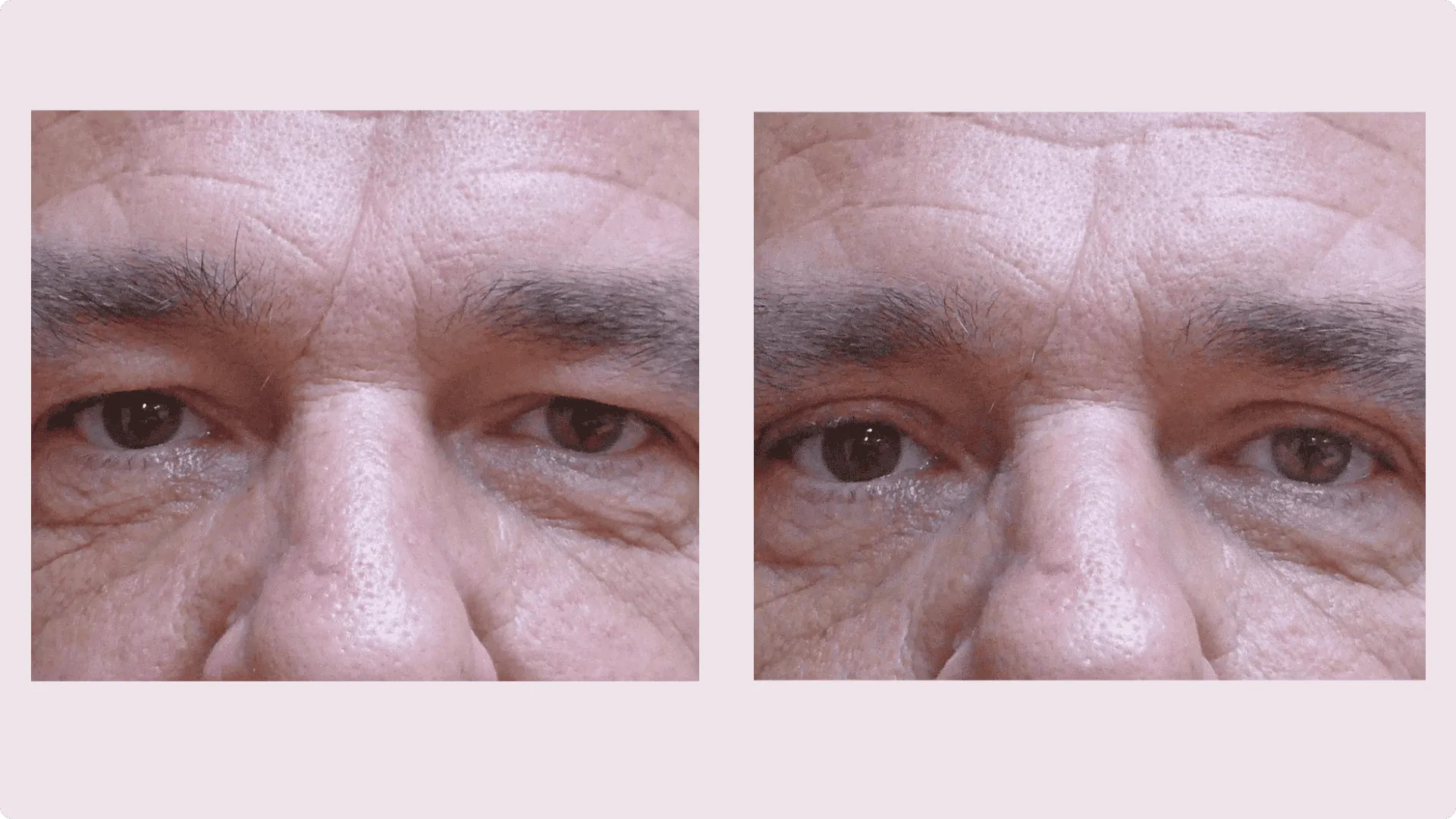 Eyelid Correction – Blepharoplasty – before and after photo 14