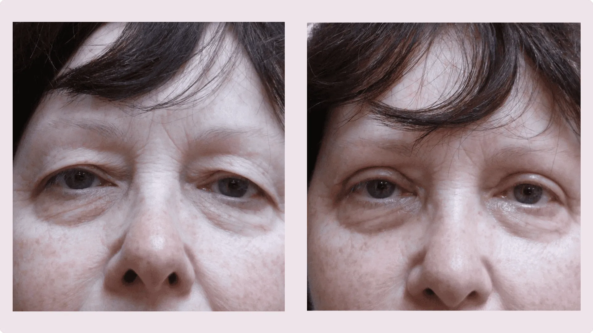 Eyelid Correction – Blepharoplasty – before and after photo 15