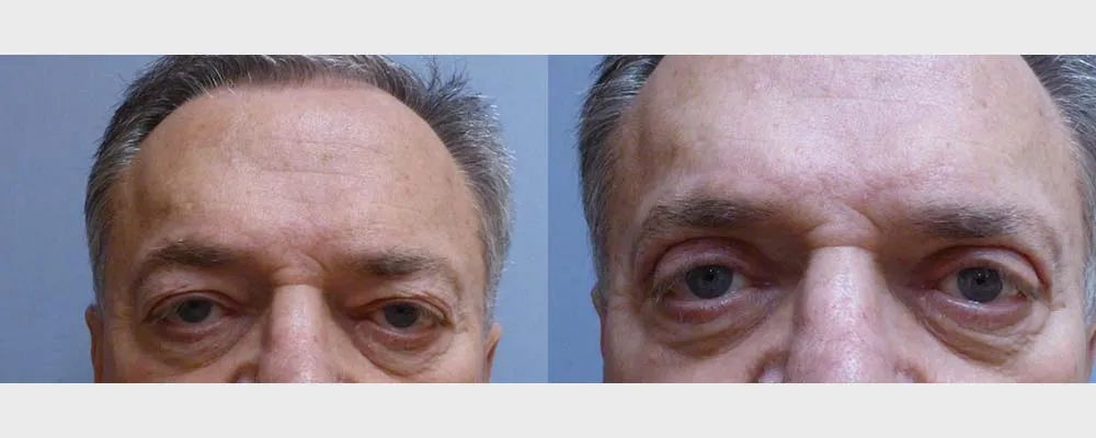 Корекція повік (Блефаропластика) – результат 1