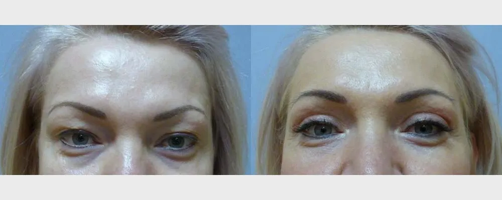 Корекція повік (Блефаропластика) – результат 2