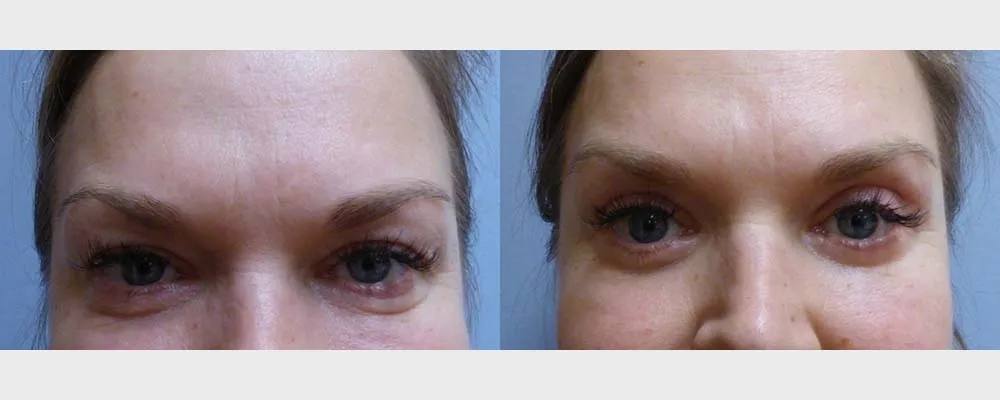 Корекція повік – Блефаропластика – результат 4