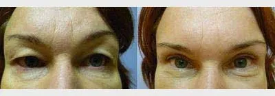 Корекція повік – Блефаропластика – результат 5