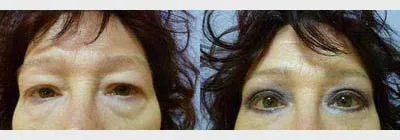 Корекція повік – Блефаропластика – результат 6