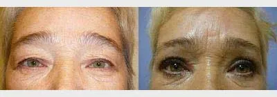 Корекція повік – Блефаропластика – результат 7