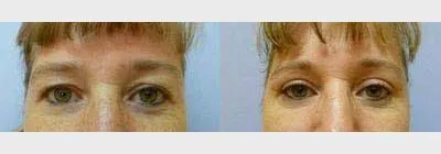 Корекція повік (Блефаропластика) – результат 3