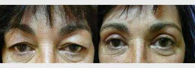 Корекція повік – Блефаропластика – результат 9
