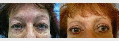 Корекція повік – Блефаропластика – результат 10